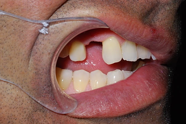 Dental-Implant-Before