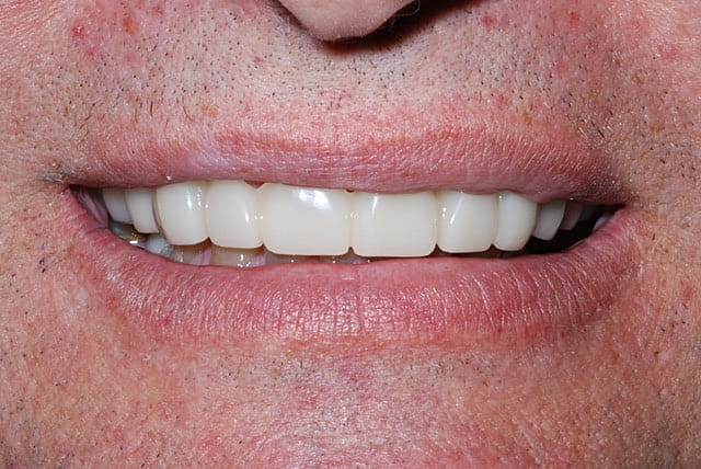 Snap-On Smile | Dentures | Cosmetic Dentist | Zimmerman Dental Care